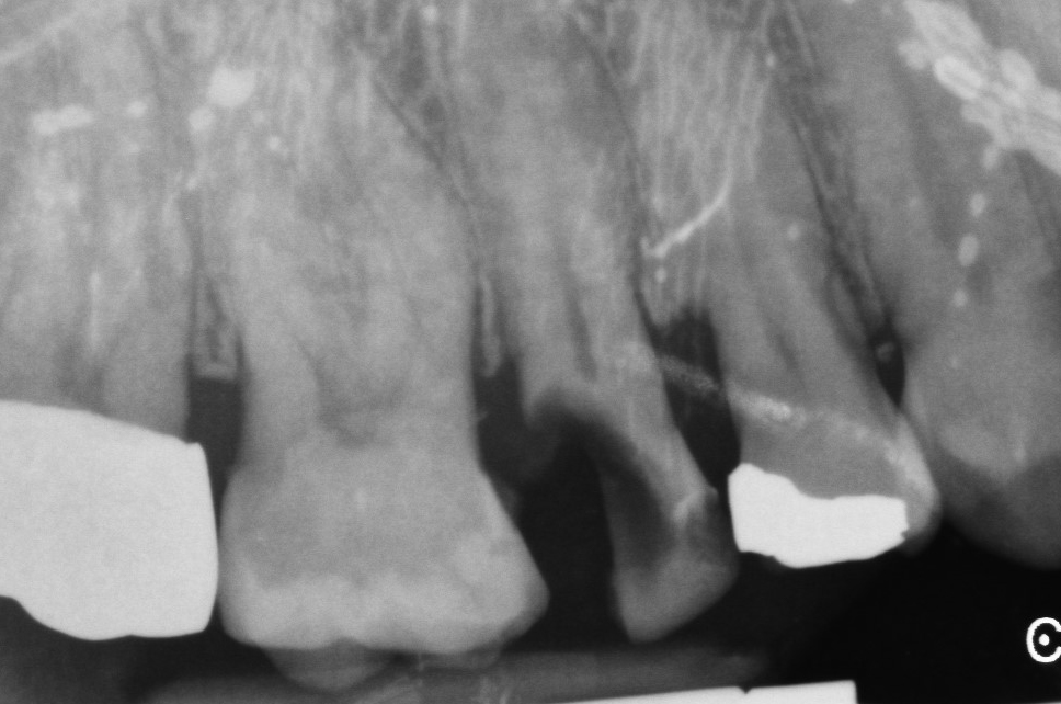 1- dente fratturato