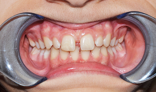 1-pre-ortodonzia trasperente con diastema