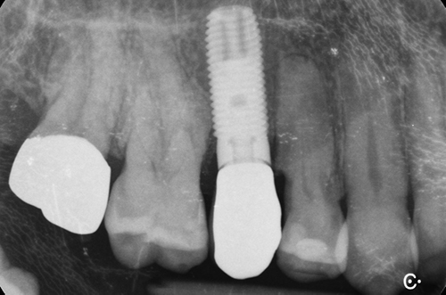 2- impianto in sostituzione di dente fratturato