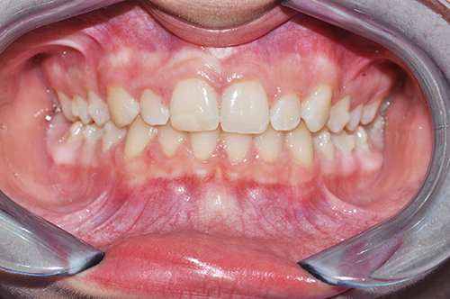 2-post-ortodonzia trasperente con diastema