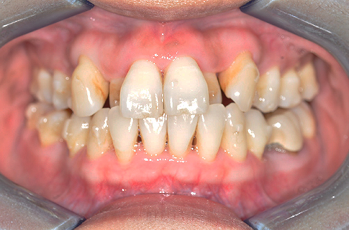 pre-ortodonzia trasparente