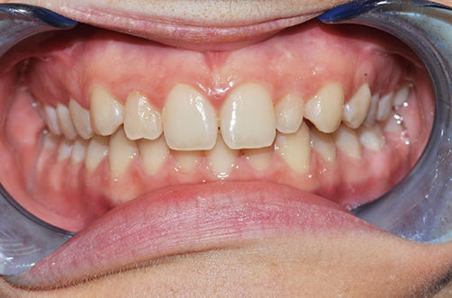 pre-ortodonzia